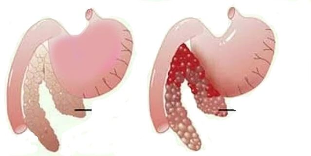 Pancreatită